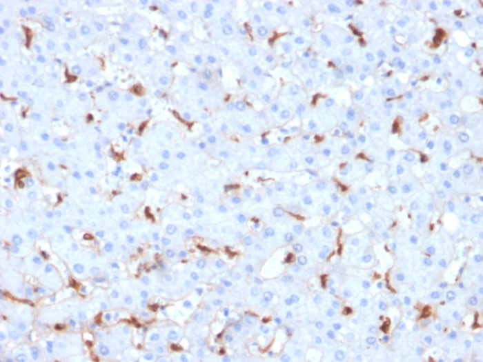 Formalin-fixed, paraffin-embedded human Hepatocellular Carcinoma stained with C1QB Mouse Monoclonal Antibody (C1QB/2961). C1QB / Complement C1q B-Chain Antibody