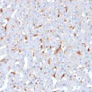 Formalin-fixed, paraffin-embedded human hepatocellular carcinoma stained with C1QB Mouse Monoclonal Antibody (C1QB/2962).