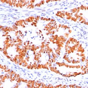 Formalin-fixed, paraffin-embedded human Colon Carcinoma stained with p53 Mouse Monoclonal Antibody (BP53-12).