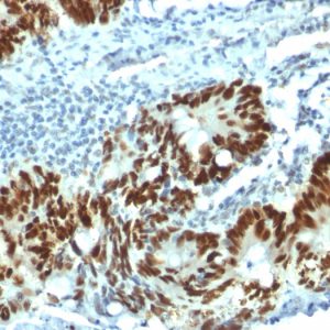 Formalin-fixed, paraffin-embedded human Colon Carcinoma stained with p53 Mouse Monoclonal Antibody (PAb1801).
