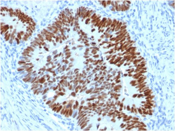 Formalin-fixed, paraffin-embedded human Colon Carcinoma stained with p53 Mouse Monoclonal Antibody (PCRP-TP53-2A10).
