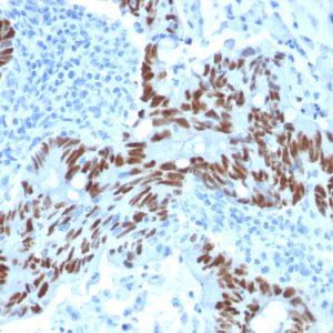 Formalin-fixed, paraffin-embedded human Colon Carcinoma stained with p53 Mouse Monoclonal Antibody (PCRP-TP53-1F7).