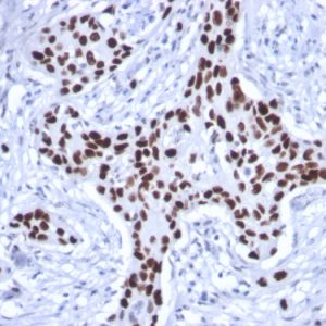 Formalin-fixed, paraffin-embedded human Breast Carcinoma stained with p53 Mouse Recombinant Monoclonal Antibody (rTP53/1739)