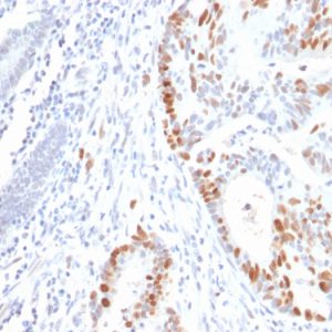 Formalin-fixed, paraffin-embedded human Colon Carcinoma stained with p53 Mouse Recombinant Monoclonal Antibody (rBP53-12).