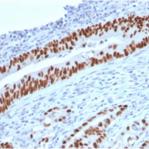 Formalin-fixed, paraffin-embedded human Colon Carcinoma stained with p53 Mouse Monoclonal Antibody (TP53/2719).