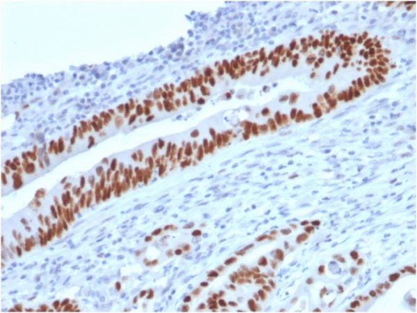 Formalin-fixed, paraffin-embedded human Colon Carcinoma stained with p53 Mouse Monoclonal Antibody (TP53/2719).
