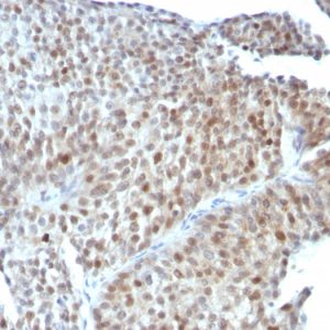 Formalin-fixed, paraffin-embedded human Bladder Carcinoma stained with p53 Monoclonal Antibody (SPM589).
