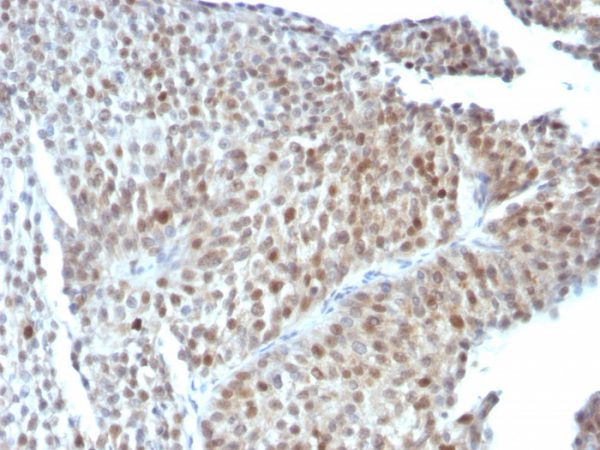 Formalin-fixed, paraffin-embedded human Bladder Carcinoma stained with p53 Monoclonal Antibody (SPM589).