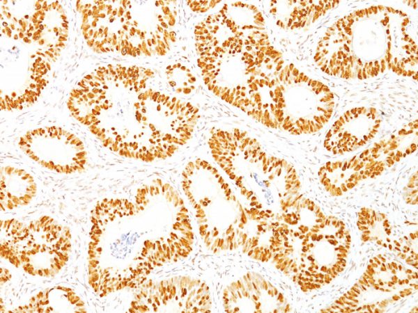 Formalin-fixed, paraffin-embedded human Colon Carcinoma stained with p53 Mouse Monoclonal Antibody (DO-7).
