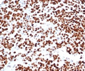 Formalin-fixed, paraffin-embedded human serous ovarian carcinoma stained with p53 Recombinant Mouse Monoclonal Antibody (rTP53/6927). HIER: Tris/EDTA, pH9.0, 45min. 2°C: HRP-polymer, 30min. DAB, 5min.