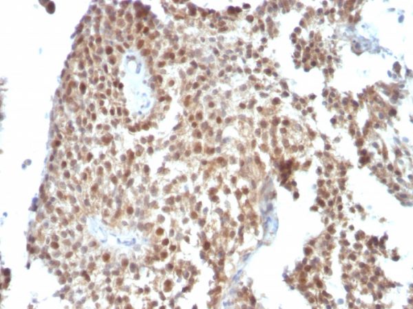 Formalin-fixed, paraffin-embedded human Bladder Carcinoma stained with p53 Monoclonal Antibody (SPM590)