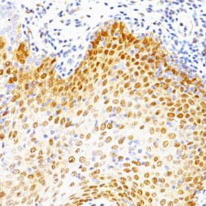 Formalin-fixed, paraffin-embedded human Cervical Carcinoma stained with p53 Monoclonal Antibody (BP53-12 + DO-7)