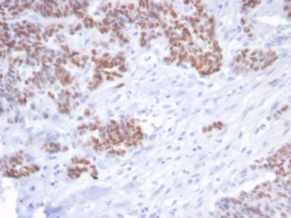 Formalin-fixed, paraffin-embedded human serous ovarian carcinoma stained with p53 Recombinant Mouse Monoclonal Antibody (rTP53/6940). HIER: Tris/EDTA, pH9.0, 45min. 2°C: HRP-polymer, 30min. DAB, 5min.