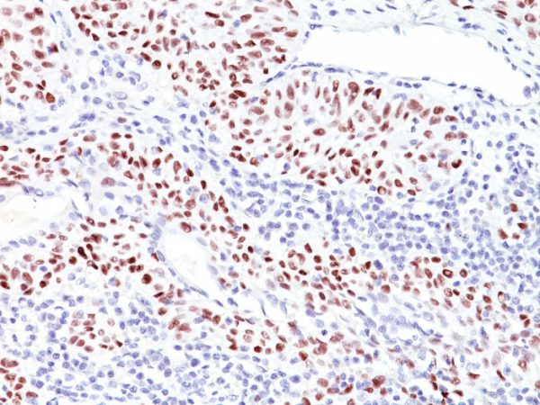 Formalin-fixed, paraffin-embedded human Bladder Carcinoma stained with p53 Mouse Monoclonal Antibody (TRP/816).