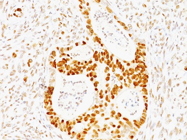 Formalin-fixed, paraffin-embedded human Colon Carcinoma stained with p53 Mouse Monoclonal Antibody (TRP/817).