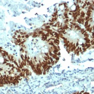 Formalin-fixed, paraffin-embedded human Colon Carcinoma stained with p53 Mouse Monoclonal Antibody (DO-1).