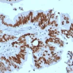Formalin-fixed, paraffin-embedded human Colon Carcinoma stained with p53 Recombinant Rabbit Monoclonal Antibody (TP53/2092R).