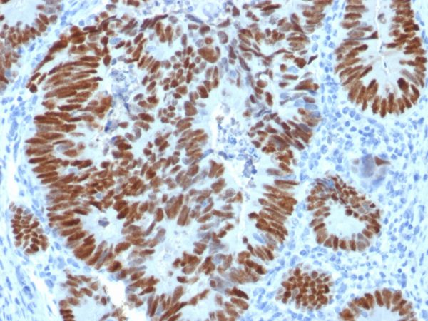 Formalin-fixed, paraffin-embedded human Colon Carcinoma stained with p53 Rabbit Polyclonal Antibody.