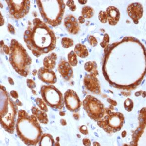 Formalin-fixed, paraffin-embedded human Thyroid Carcinoma stained with Thyroid Peroxidase Mouse Monoclonal Antibody (TPO/1921).