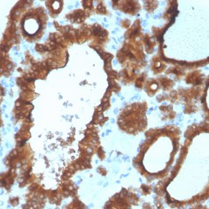 Formalin-fixed, paraffin-embedded human Thyroid Carcinoma stained with Thyroid Peroxidase Mouse Monoclonal Antibody (TPO/3700).