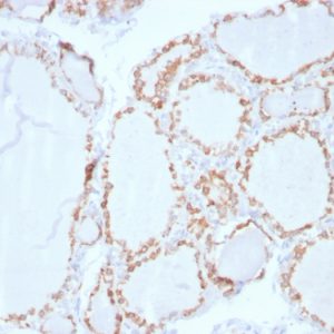 Formalin-fixed, paraffin-embedded human Thyroid Carcinoma stained with Thyroid Peroxidase Mouse Monoclonal Antibody (TPO/3702).