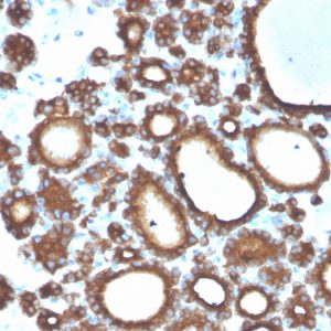 Formalin-fixed, paraffin-embedded human thyroid carcinoma stained with Thyroid Peroxidase Mouse Monoclonal Antibody (TPO/3694).