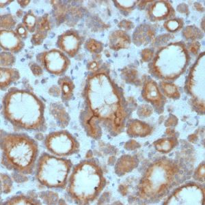 Formalin-fixed, paraffin-embedded human Thyroid Carcinoma stained with Thyroid Peroxidase Mouse Monoclonal Antibody (TPO/3695).