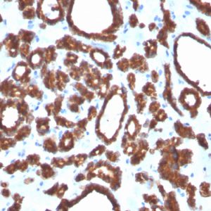 Formalin-fixed, paraffin-embedded human Thyroid Carcinoma stained with Thyroid Peroxidase Mouse Monoclonal Antibody (TPO/3697).