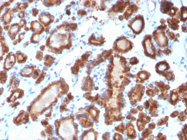 Formalin-fixed, paraffin-embedded human Thyroid Carcinoma stained with Thyroid Peroxidase Mouse Monoclonal Antibody (TPO/3698).