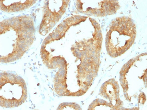 Formalin-fixed, paraffin-embedded human Breast Carcinoma stained with GRP94 Rat Monoclonal Antibody (9G10.F8.2).