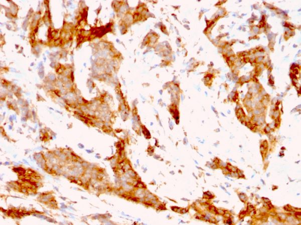 Formalin-fixed, paraffin-embedded human Breast Carcinoma stained with GRP94 Rat Monoclonal Antibody (9G10.F8.2).