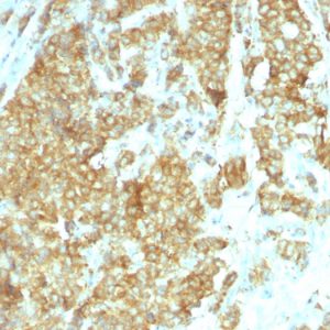 Formalin-fixed, paraffin-embedded human Breast Carcinoma stained with GRP94 Monoclonal Antibody (HSP90B1/1192).