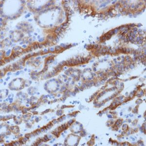 Formalin-fixed, paraffin-embedded human Thyroid Carcinoma stained with TSHRB Monoclonal Antibody (SPM222).