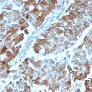 Formalin-fixed, paraffin-embedded human Renal Cell Carcinoma stained with OX40 Mouse Monoclonal Antibody (OX40/3108).