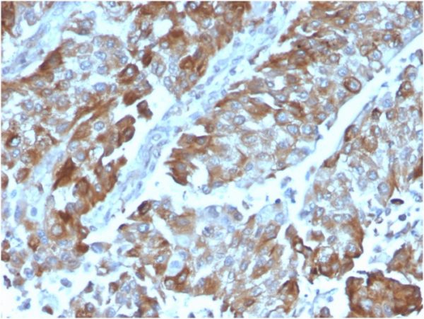 Formalin-fixed, paraffin-embedded human Renal Cell Carcinoma stained with OX40 Mouse Monoclonal Antibody (OX40/3108).