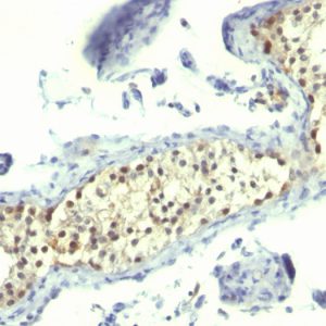 Formalin-fixed, paraffin-embedded human testicular carcinoma stained with Thymidylate Synthase Mouse Monoclonal Antibody (TS106).