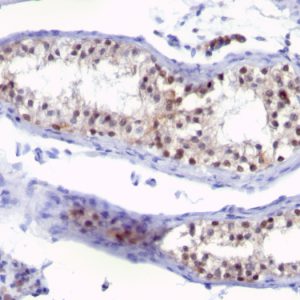 Formalin-fixed, paraffin-embedded human testicular carcinoma stained with Thymidylate Synthase Mouse Monoclonal Antibody (SPM453).