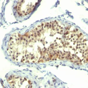 Formalin-fixed, paraffin-embedded human testicular carcinoma stained with Thymidylate Synthase Mouse Monoclonal Antibody (TMS715).