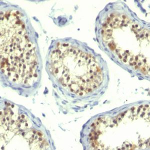 Formalin-fixed, paraffin-embedded human Testicular Carcinoma stained with Thymidylate Synthase Monoclonal Antibody (TS106 + TMS715).