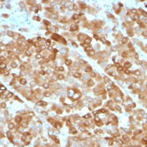 Formalin-fixed, paraffin-embedded melanoma stained with Tyrosinase Monoclonal Antibody (OCA1/812).