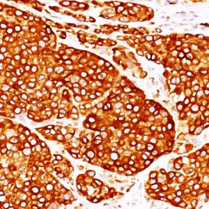 Formalin-fixed, paraffin-embedded human melanoma stained with Tyrosinase Mouse Monoclonal Antibody (T311 + OCA1/812).