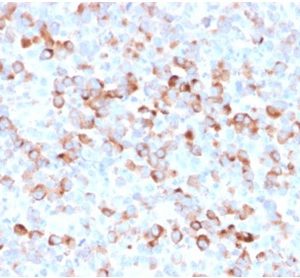 Formalin-fixed, paraffin-embedded Melanoma stained with Tyrosinase MouseRecombinant Monoclonal Antibody (rOCA1/812).