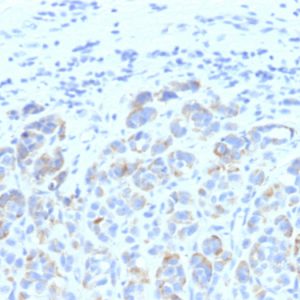 Formalin-fixed, paraffin-embedded human Melanoma stained with TYRP1 MAB (SPM611)
