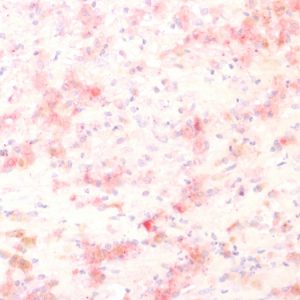 Formalin-fixed, paraffin-embedded human Melanoma stained with TYRP1 Rabbit Recombinant Monoclonal Antibody (TYRP1/1564R)  using AEC Chromogen.