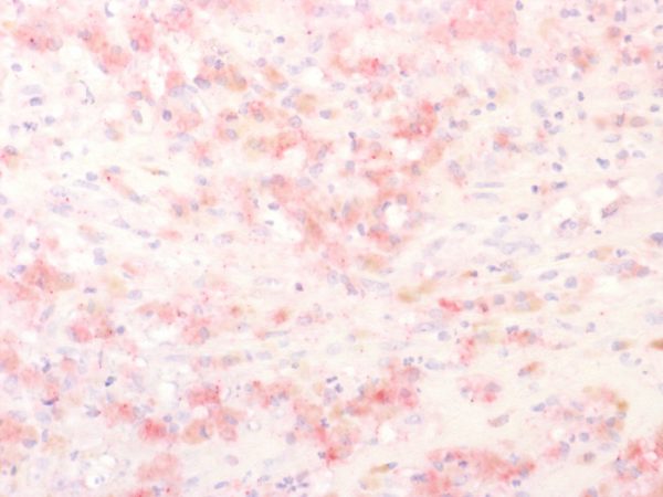 Formalin-fixed, paraffin-embedded human Melanoma stained with TYRP1 Recombinant Rabbit Monoclonal (TYRP1/2340R); AEC Chromogen.