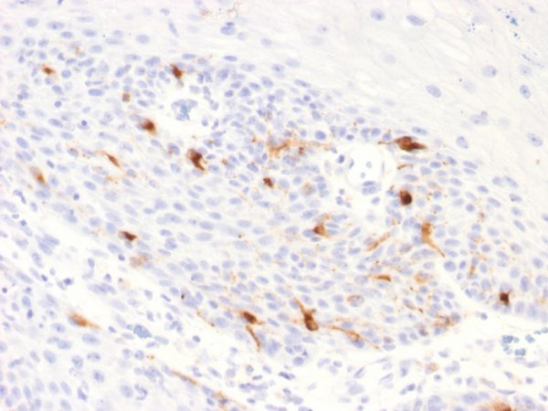 Formalin-fixed, paraffin-embedded human Basal Cell Carcinoma stained with TYRP1 Recombinant Rabbit Monoclonal Antibody (TYRP1/2340R).