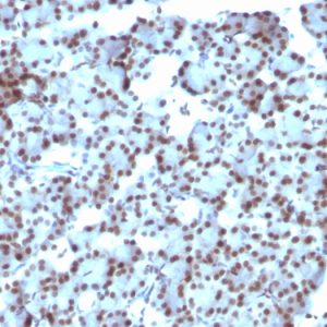 Formalin-fixed, paraffin-embedded human Ovarian Carcinoma stained with SUMO-1 Monoclonal Antibody (SUMO1/1188)