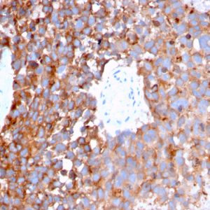 Formalin-fixed, paraffin-embedded human Urothelial Carcinoma stained with Monospecific Mouse Monoclonal Antibody to Uroplakin 1B (UPK1B/3273).