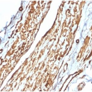 Formalin-fixed, paraffin-embedded human testicular carcinoma stained with Vinculin Mouse Monoclonal Antibody (VCL/2575) at 2ug/ml.