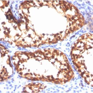 Formalin-fixed, paraffin-embedded human Testicular Carcinoma stained with VCL-Monospecific Mouse Monoclonal Antibody (VCL/3617).